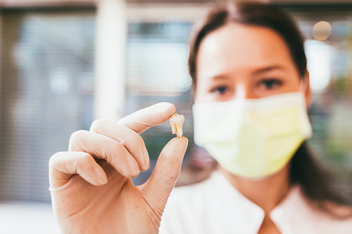 An extracted tooth after a successful oral pathology procedure at Bay Lakes Center for Complex Dentistry in Green Bay, WI.